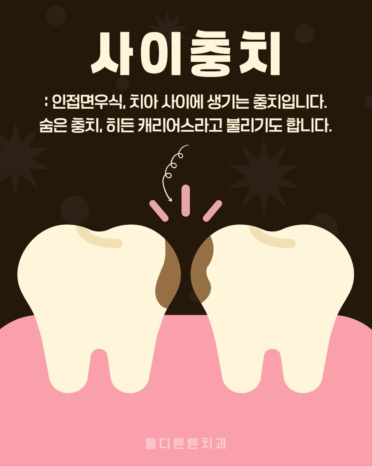 치아 사이 충치 치과 정보 광고