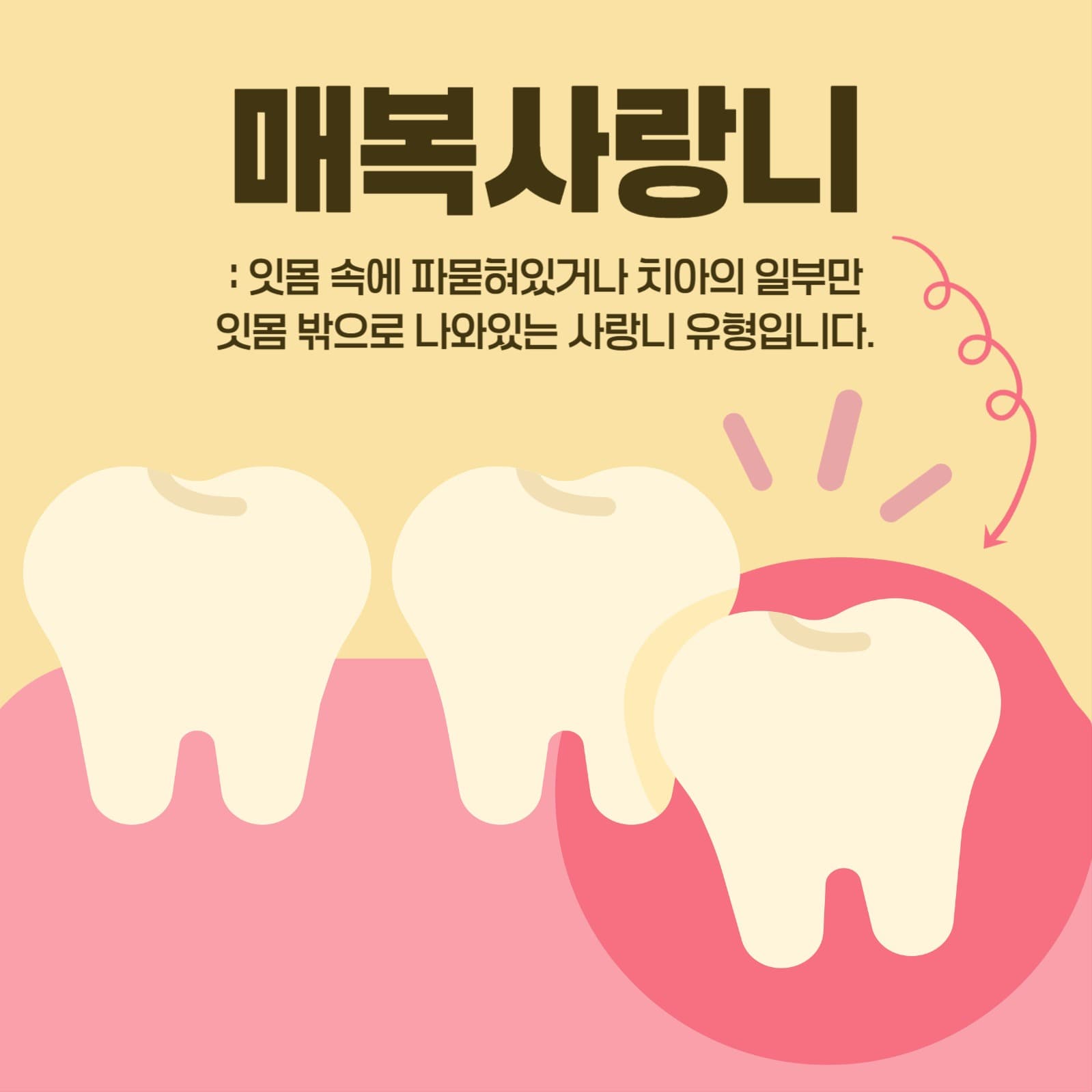 치과 매복사랑니 사랑니 치아 카드뉴스